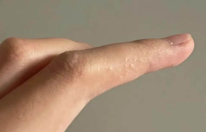 这种夏天手上爱长的小水疱 到底是什么?